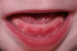 Close-up of a teething baby's mouth.