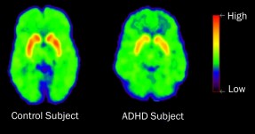 adhd Photo of brain activity of adhd kids.