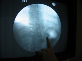 Photo of a stomech with a lapband.